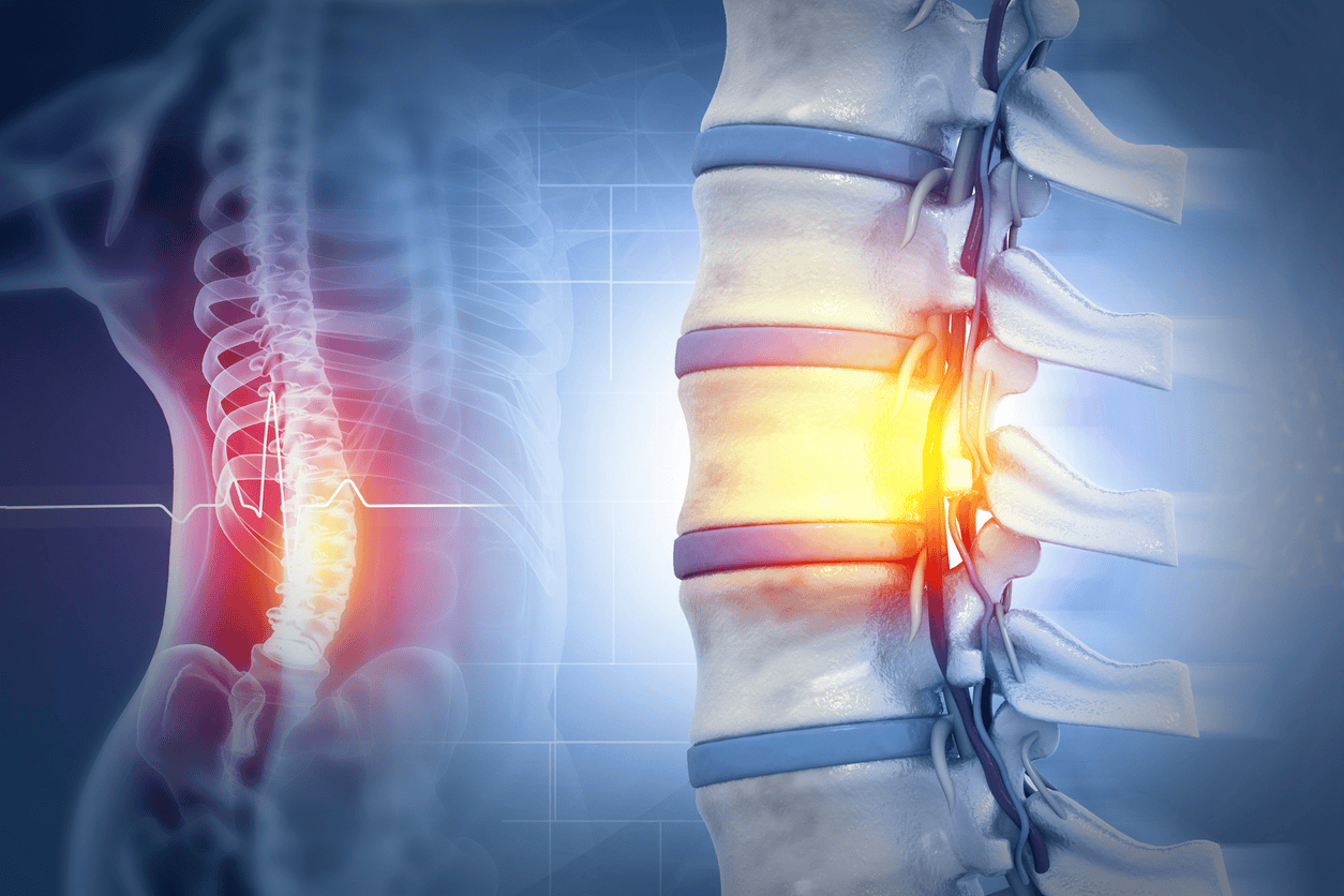 The image shows an illustration of the spine with highlighted areas of injury, indicating pain.